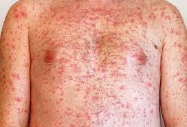 Image result for Skin Infection