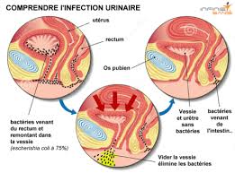 Quelques mesures générales peuvent être appliquées pour réduire le risque d'infection urinaire attention : Cystite Infections Urinaires Les Causes Symptomes Traitements