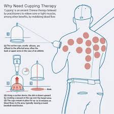 Cupping Points Chart Pdf 2019 Cupping Therapy Acupuncture