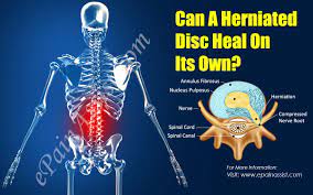 Check spelling or type a new query. Can A Herniated Disc Heal On Its Own