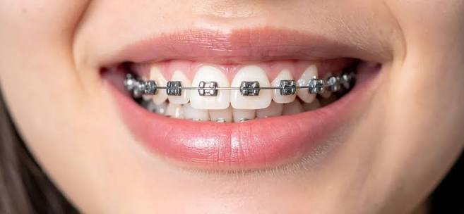 How Long Do You Have to Wear Metal Braces