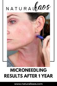 Pin On Microneedling