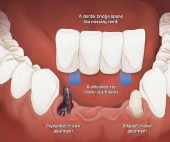 A bridge is typically made of crowns on either side of the missing tooth or teeth supporting the pontic (false tooth) and is cemented in place. Dental Bridges Elite Dental Group