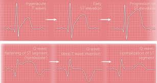 Image result for ST Elevation