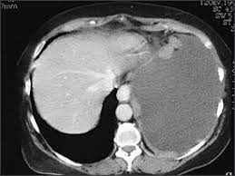 Check spelling or type a new query. Diagnostic Approach To Pleural Effusion In Adults American Family Physician