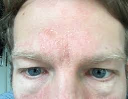 Douglas.de has been visited by 10k+ users in the past month How I Cured Rosacea Using Azelaic Acid Before After Pics Minimal Fit