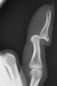 Image result for DIP Dislocation