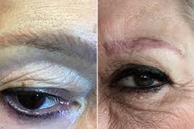 Support each other, post your before and afters, and talk with me and your fellow la. The Dark Side Of Microblading New York Post