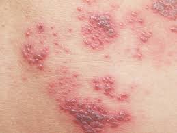 If you did have chickenpox, it's reassuring to know that i. What Is Shingles Identify Early Stages And Symptoms Healthpartners Blog
