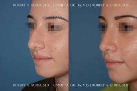 Some people are born with a deviated septum. Deviated Septum Vs Bump On Nose Robert A Guida Md Plastic And Rhinoplasty Surgeon