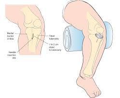 Image result for Intraosseous Access