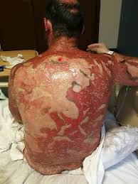 If you have time before you go: Dermatological Emergencies Stevens Johnson Syndrome International Emergency Medicine Education Project