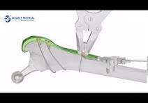 Double Medical Cable Plate System