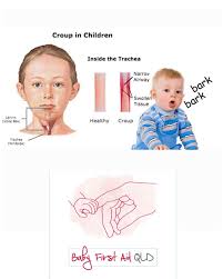 Image result for Croup