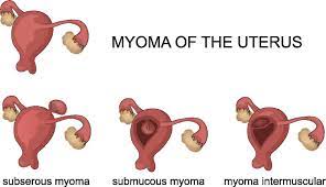 Mooci Myom Gutartiges Tumorgebilde Am Uterus