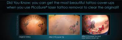 95 new litchfield street, torrington, ct 06790. Picosure Laser Tattoo Removal Treatment In Fairfield Ct