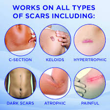 How to get rid of keloid scars. Amazon Com Keloda Scar Keloid Removal Oil Massager 0 3 Oz For Treatment Of Surgical Scars Piercing Keloids Acne Stretch Marks Burns With Cocoa Shea Butter