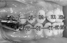 A mara functional appliance is one of many tooth born appliance design to increase growth in the lower jaw. Figure 1 From Treatment Timing Of Mara And Fixed Appliance Therapy Of Class Ii Malocclusion Semantic Scholar