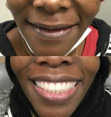 Make sure you find a dentist with many years experience in dentures. Dentures Memphis Dentures And Implants