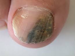 Image result for Acral lentiginous melanoma nail