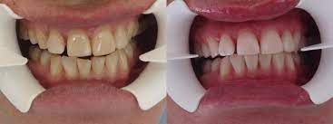 Do not leave any gel on the gums because this will cause irritation to your gums. 3 Big Benefits Of Zoom Teeth Whitening By Brunswicksqdental Medium