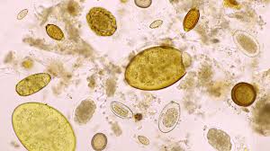 Image result for thin ribbon stools human poop