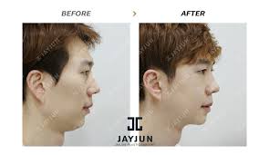 Korean Plastic Surgery Korea Cosmetic Surgery Korean Plastic Surgery Before And After Korean Plastic Surgery Plastic Surgery Korea South Korea Plastic Surgery