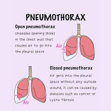 Image result for Open Pneumothorax