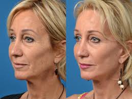 Laser Assisted Weekend Neck Lift Photos Melbourne Fl Patient 52568
