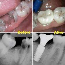Before On The Left Side Is A Picture And X Ray Of A Tooth That Cannot Be Restored So It Is Extracted After On The Dental Dental Implants Implant Dentistry