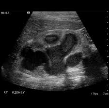 Pyonephrosis Is A Term Given To Infection Of The Renal Pelvic System Which Can Then Subsequently Get Filled Radiology Diagnostic Medical Sonography Ultrasound