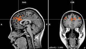 Abstract in this event‐related functional magnetic resonance imaging (fmri) study, we provide evidence that the role of the anterior cingulate cortex (acc) in cognitive control may not be unitary, as the responses of different acc subregions vary depending upon the nature of task‐irrelevant information. Pin On Neuroscience Articles