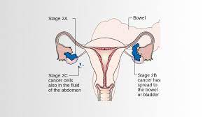 Ovarian cancer signs & symptoms can be hard to detect, but may include abdominal bloating or swelling. Ovarian Cancer Pictures Symptoms And Diagnosis