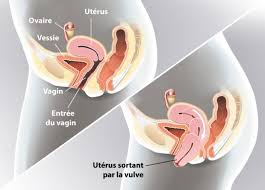 Au quotidien, le prolapsus génital peut se révéler gênant et inconfortable. Lyon Gyneco Le Prolapsus