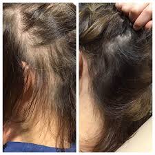 Hair loss arising from lots of clinical circumstances could be corrected devoid of surgical treatment. Prp Hair Restoration Chicago Hair Loss Treatment Wicker Park Il