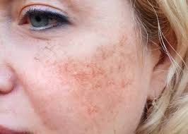 Image result for Melasma