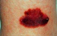 Also, if you feel better for a couple days and then nor can we say exactly how long you may be contagious. Melanoma Facts Seattle Cancer Care Alliance