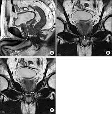 The Membranous Urethral Length Is Measured In The A Sagittal And B Download Scientific Diagram