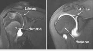 Image result for Shoulder MRI