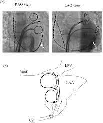 These 2 foci are fixed and never move. Clinical Significance Of Arrhythmogenic Foci In Atrial Fibrillation Intechopen