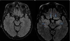 Mri is superior to ct scanning for demonstrating cerebral toxoplasmosis. Fulminant Herpes Simplex Encephalitis With Normal Initial Mri Findings Consultant360
