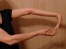 Pin On Eds3 Hypermobility Syndrome Bjhs Chronic Pain