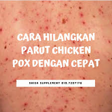 Terdapat 3 cara bagaimana chicken pox merebak, iaitu malahan, jika menggaru dengan kuat sehingga berdarah dan keruping terkopek, ia akan meninggalkan kesan parut yang sukar dihilangkan. Cara Hilangkan Parut Chicken Pox Dengan Cepat Pengedar Shaklee Sah Malaysia