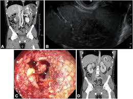 Image result for Splenic Abscess