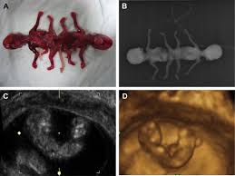Check spelling or type a new query. Conjoined Twins Detected In The First Trimester A Review Sciencedirect