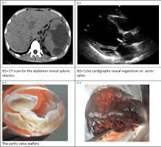 Image result for Splenic Abscess