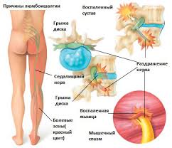 Lyumboishalgiya Lechenie Simptomy Prichiny Diagnostika Centr Dikulya