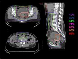 Maybe you would like to learn more about one of these? Dose Distribution Of C Ion Rt Isodose Curves Of Carbon Ion Radiotherapy For Locally Advanced Cervical Cancer Are Superimposed On Axial And Sagittal Computed Tomography Images For The Total Irradiation Plan