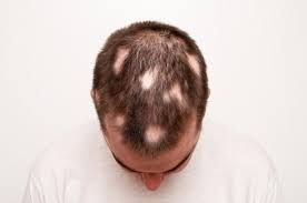 Maybe you would like to learn more about one of these? Rambut Rontok Bisa Jadi Tanda 7 Penyakit Ini