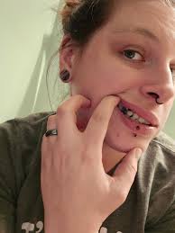 Frustration with Tooth Decay Removal